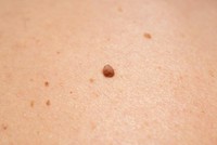 symptomes-papillomavirus-homme