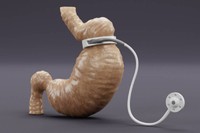 avantages-pose-anneau-gastrique