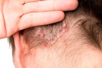 psoriasis-cuir-chevelu-traitement