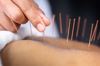 acupuncture-pour-maigrir-menopause