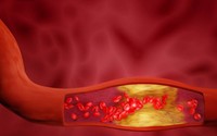 quel-est-le-mauvais-cholesterol