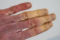 qu-est-ce-que-le-syndrome-de-raynaud