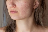 acne-hormonale-traitement-naturel