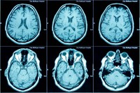 image-anormale-irm-cerebrale