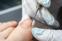 ongle-incarne-stade-2