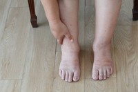 autres-facteurs-pieds-gonfles