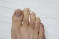 maladie-de-raynaud-traitement