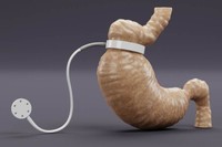 qu-est-ce-qu-un-anneau-gastrique