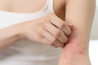 eczema-cuir-chevelu