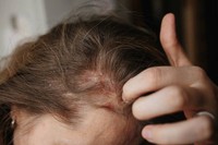 psoriasis-perte-de-cheveux