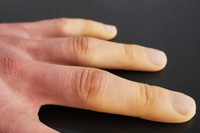 syndrome-de-raynaud-traitement