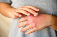 eczema-cortisone