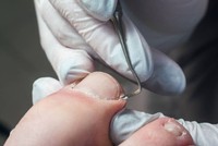ongle-incarne-pied