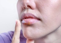aciclovir-posologie