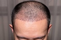 greffe-de-cheveux-2-mois-apres