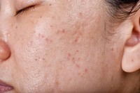 creme-acne-hormonale