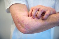 psoriasis-traitement-efficace