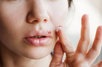 herpes-buccal-cause