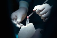 duree-hospitalisation-biopsie-prostate