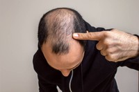 diagnostic-chute-cheveux-homme