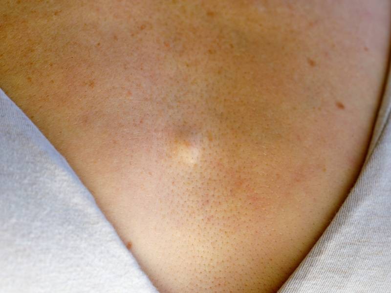 Kyste sébacé : causes et traitements | Charles.co