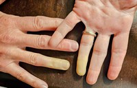 syndrome-de-raynaud-cause