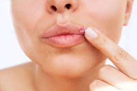 aciclovir-creme-efficace