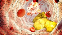 cholesterol-ldl-haut