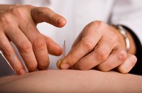 acupuncture-pour-maigrir-du-ventre