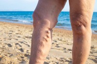 quels-sont-les-premiers-signes-de-phlebite
