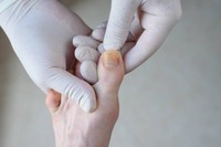 comment-soigner-une-mycose-des-pieds