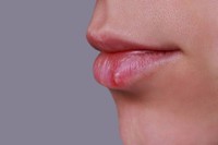 herpes-labial-cause