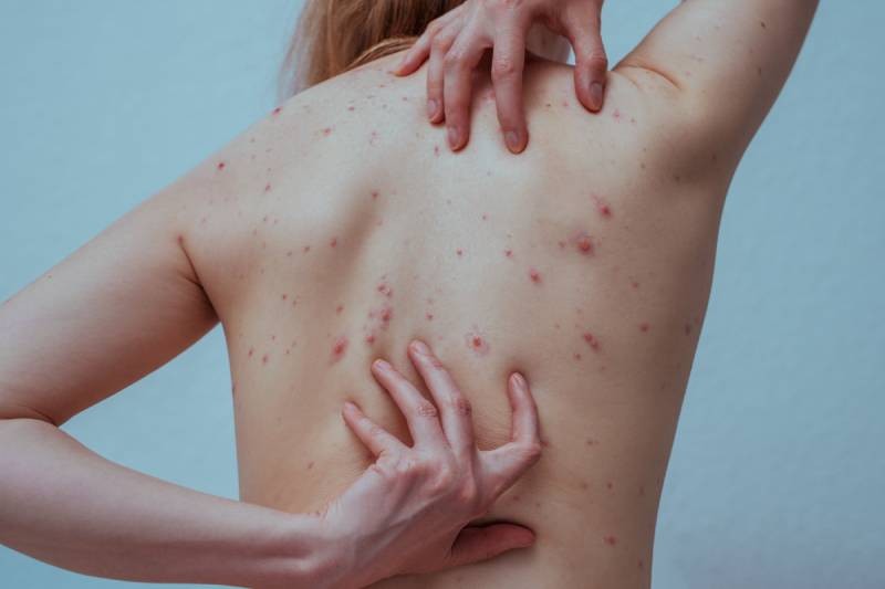 Bouton varicelle : causes, évolution, traitements et prévention