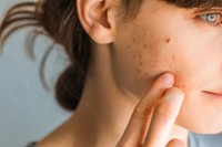 acne-hormonale-traitement-efficace