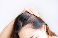 causes-perte-de-cheveux-devant-crane-femme