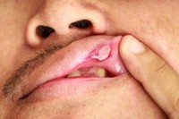 chancre-bouche