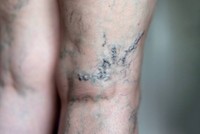 comment-soulager-une-varice-douloureuse