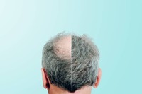 greffe-de-cheveux-avis