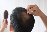 types-alopecie