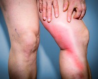 symptomes-phlebite-mollet