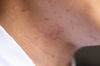herpes-circine-symptomes