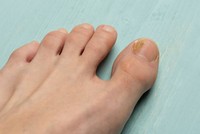mycose-ongle-pied