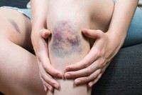 comment-aider-son-hematome-a-se-resorber
