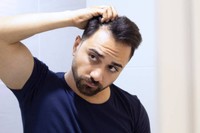 comment-savoir-si-on-a-une-calvitie