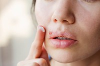 homeopathie-herpes-labial