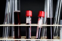 phosphatase-alcaline-elevee