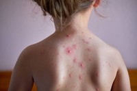 prevenir-boutons-varicelle