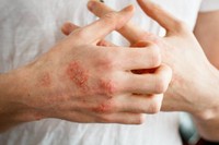 eczema-stress