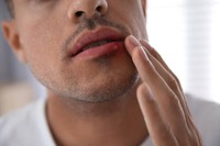 herpes-labial-contagion