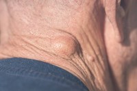 kyste-sebace-testicule